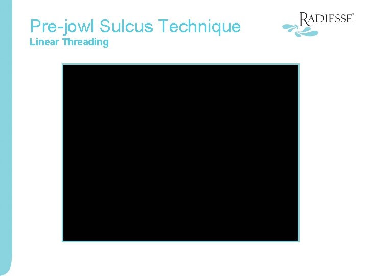 Pre-jowl Sulcus Technique Linear Threading 