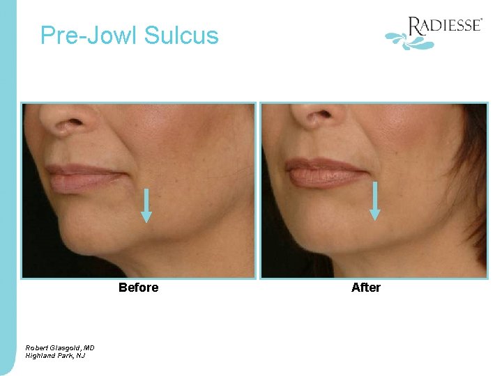 Pre-Jowl Sulcus Before Robert Glasgold, MD Highland Park, NJ After 