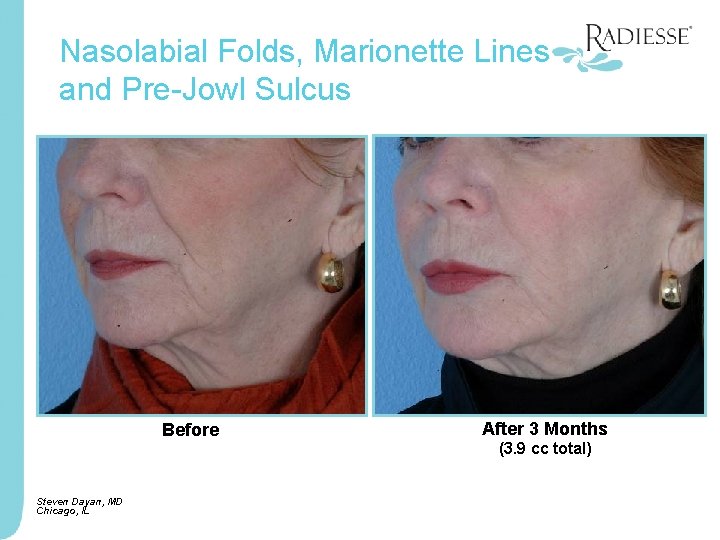Nasolabial Folds, Marionette Lines and Pre-Jowl Sulcus Before Steven Dayan, MD Chicago, IL After