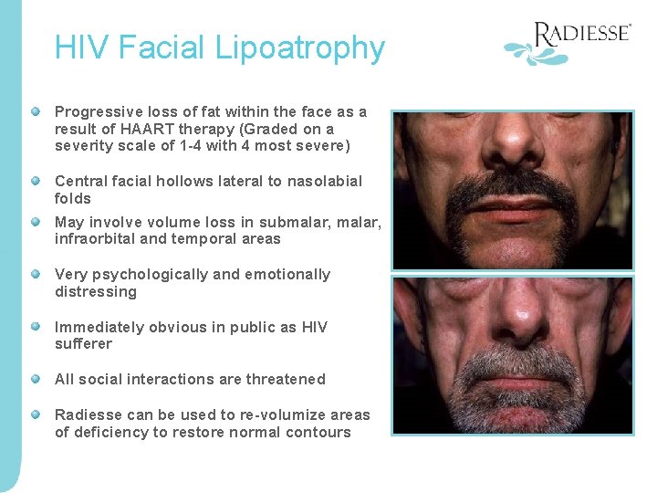 HIV Facial Lipoatrophy Progressive loss of fat within the face as a result of