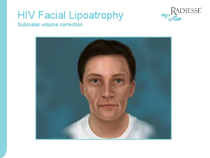 HIV Facial Lipoatrophy Submalar volume correction 