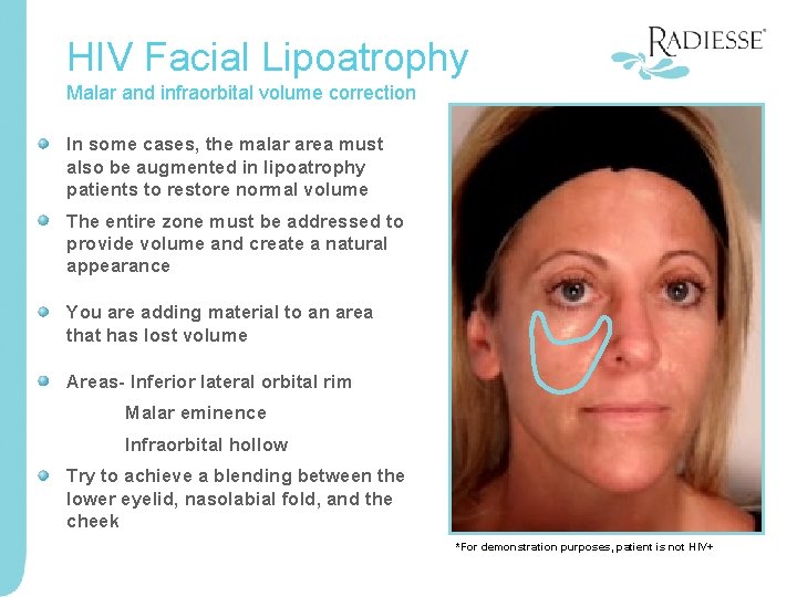 HIV Facial Lipoatrophy Malar and infraorbital volume correction In some cases, the malar area