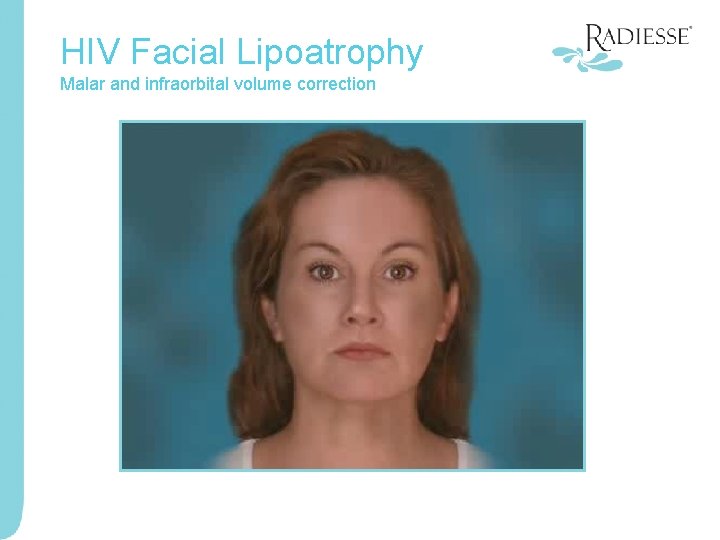 HIV Facial Lipoatrophy Malar and infraorbital volume correction 