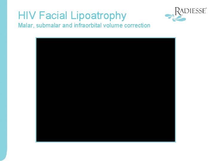 HIV Facial Lipoatrophy Malar, submalar and infraorbital volume correction 