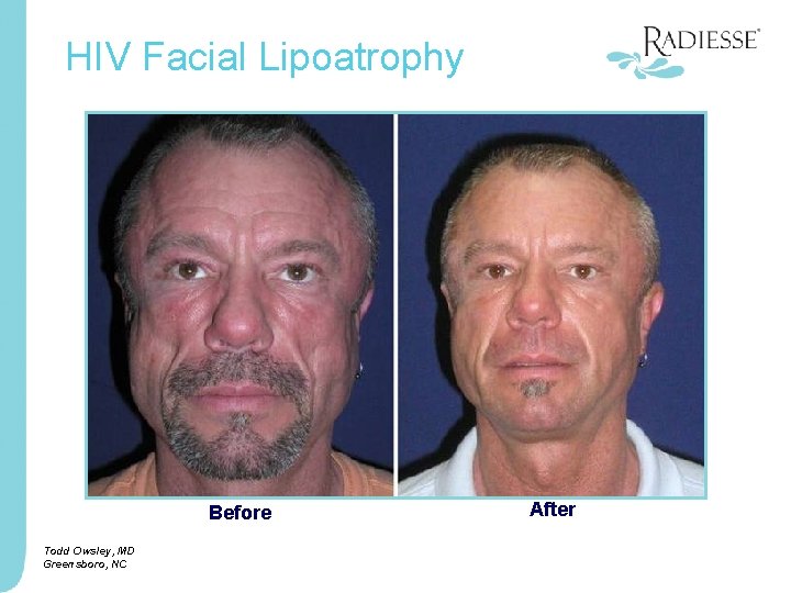 HIV Facial Lipoatrophy Before Todd Owsley, MD Greensboro, NC After Courtesy of, Todd Owsley,