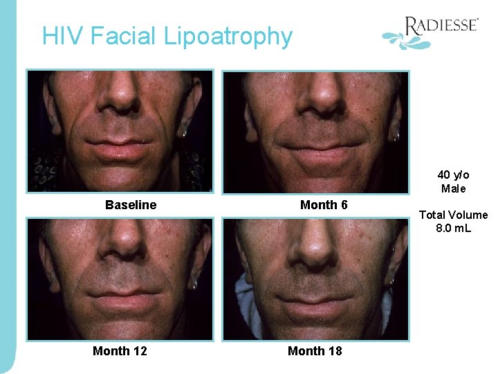 HIV Facial Lipoatrophy 40 y/o Male Baseline Month 12 Month 6 Month 18 Total