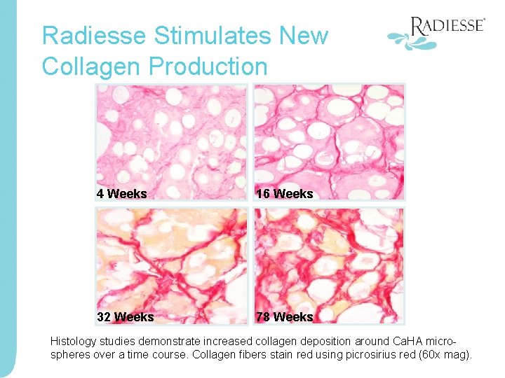 Radiesse Stimulates New Collagen Production 4 Weeks 16 Weeks 32 Weeks 78 Weeks Histology