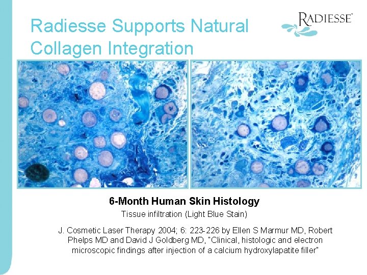 Radiesse Supports Natural Collagen Integration 6 -Month Human Skin Histology Tissue infiltration (Light Blue