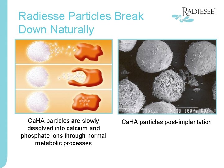 Radiesse Particles Break Down Naturally Ca. HA particles are slowly dissolved into calcium and