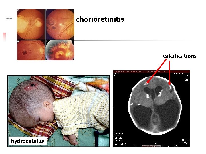 chorioretinitis calcifications hydrocefalus 