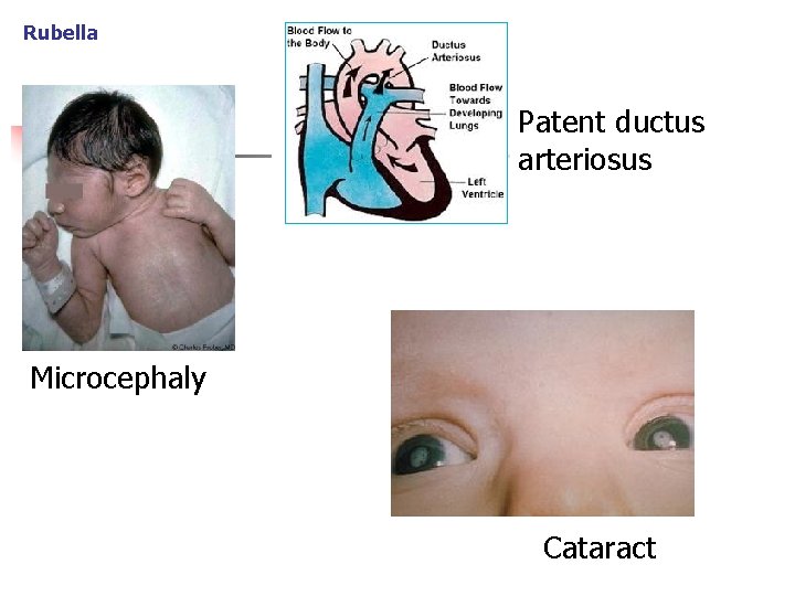 Rubella Patent ductus arteriosus Microcephaly Cataract 