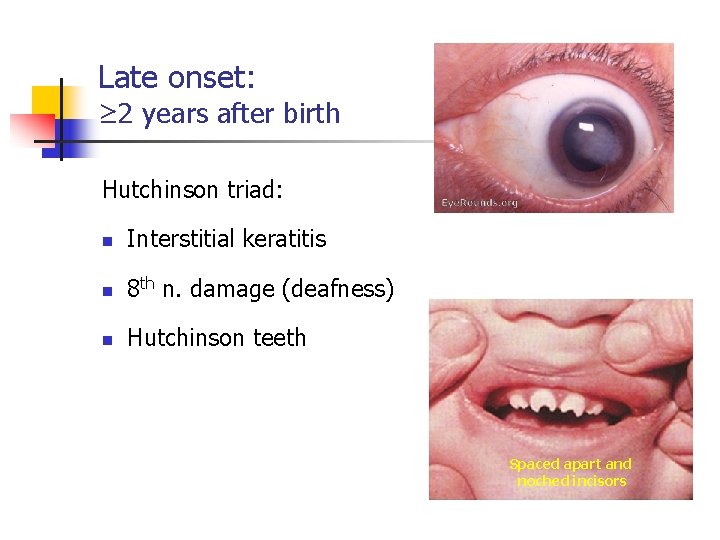 Late onset: ≥ 2 years after birth Hutchinson triad: n Interstitial keratitis n 8