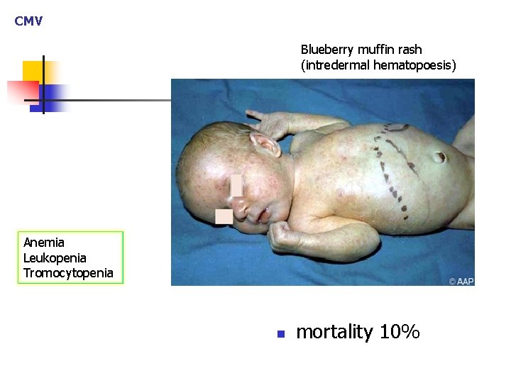 CMV Blueberry muffin rash (intredermal hematopoesis) Anemia Leukopenia Tromocytopenia n mortality 10% 