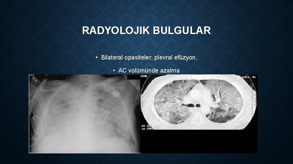 RADYOLOJIK BULGULAR • Bilateral opasiteler, plevral efüzyon, • AC volümünde azalma 