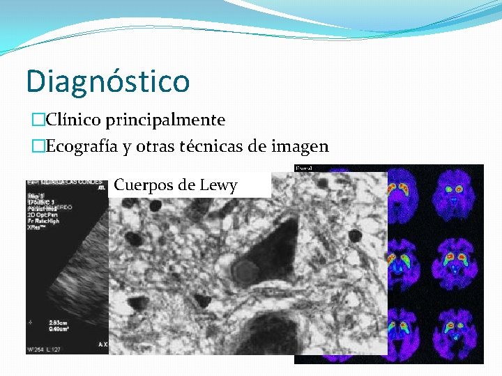 Diagnóstico �Clínico principalmente �Ecografía y otras técnicas de imagen Cuerpos de Lewy 