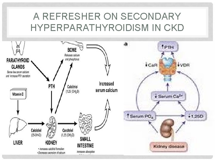 A REFRESHER ON SECONDARY HYPERPARATHYROIDISM IN CKD 