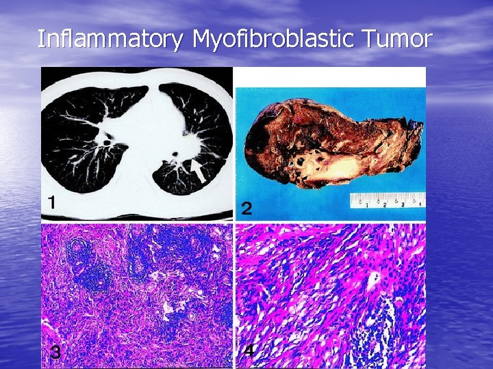 Inflammatory Myofibroblastic Tumor 