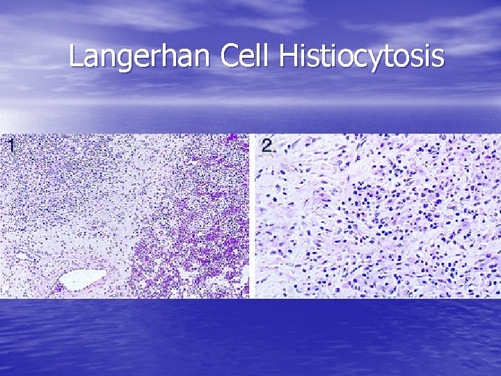 Langerhan Cell Histiocytosis 