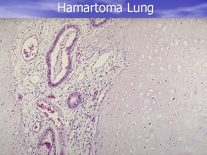 Hamartoma Lung 