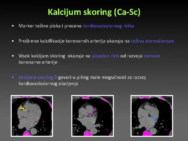 Kalcijum skoring (Ca-Sc) • Marker težine plaka i procena kardiovaskularnog rizika • Proširene kalcifikacije Kalcijum skoring (Ca-Sc) • Marker težine plaka i procena kardiovaskularnog rizika • Proširene kalcifikacije