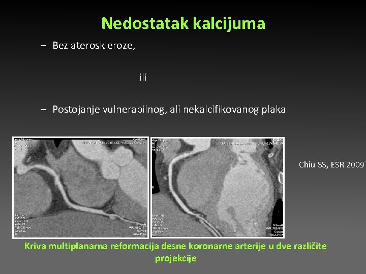 Nedostatak kalcijuma – Bez ateroskleroze, ili – Postojanje vulnerabilnog, ali nekalcifikovanog plaka Chiu SS, Nedostatak kalcijuma – Bez ateroskleroze, ili – Postojanje vulnerabilnog, ali nekalcifikovanog plaka Chiu SS,