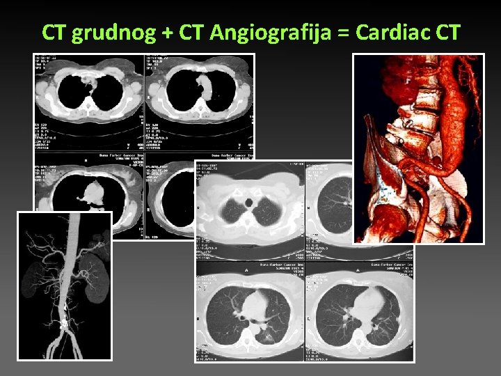 CT grudnog + CT Angiografija = Cardiac CT CT grudnog + CT Angiografija = Cardiac CT