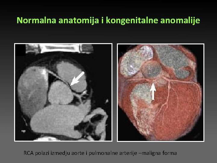 Normalna anatomija i kongenitalne anomalije RCA polazi izmedju aorte i pulmonalne arterije –maligna forma Normalna anatomija i kongenitalne anomalije RCA polazi izmedju aorte i pulmonalne arterije –maligna forma