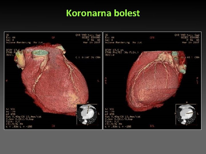 Koronarna bolest Koronarna bolest