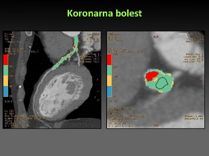 Koronarna bolest Koronarna bolest