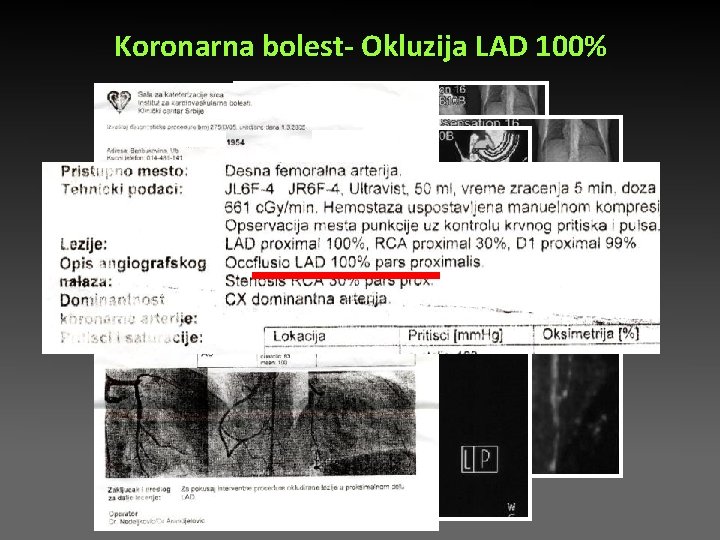 Koronarna bolest- Okluzija LAD 100% Koronarna bolest- Okluzija LAD 100%
