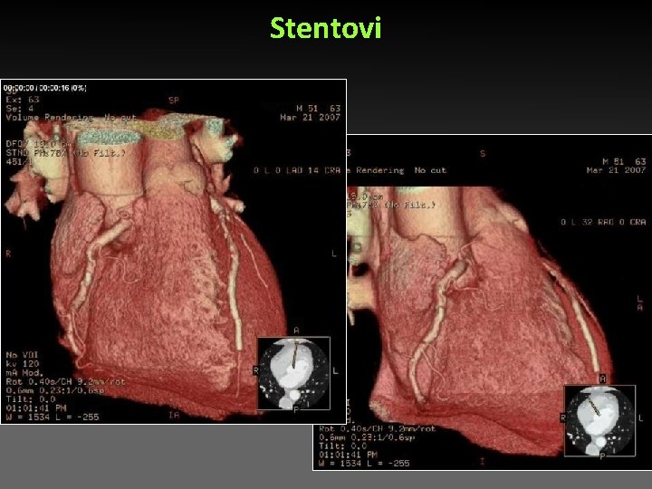 Stentovi Stentovi