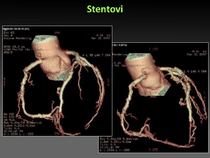 Stentovi Stentovi
