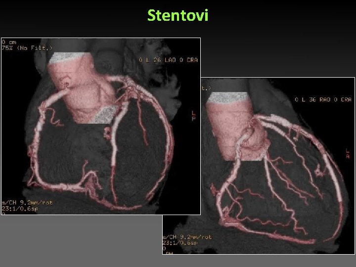 Stentovi Stentovi