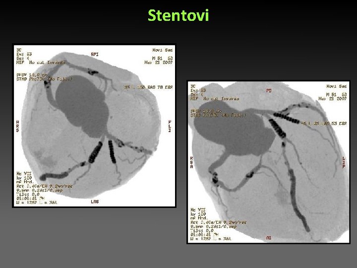 Stentovi Stentovi