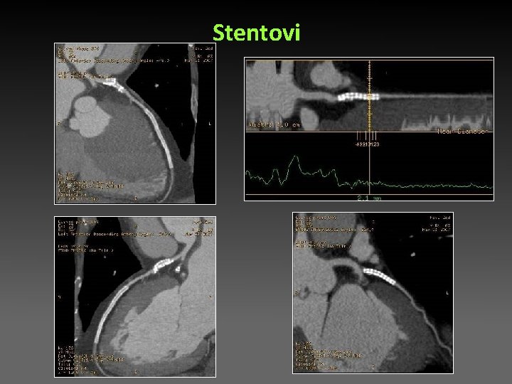 Stentovi Stentovi