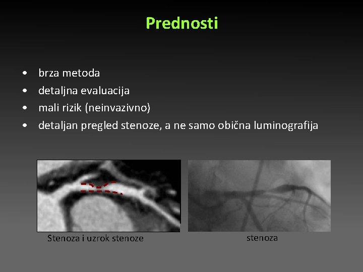 Prednosti • • brza metoda detaljna evaluacija mali rizik (neinvazivno) detaljan pregled stenoze, a Prednosti • • brza metoda detaljna evaluacija mali rizik (neinvazivno) detaljan pregled stenoze, a