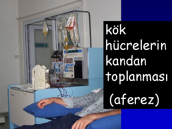 kök hücrelerin kandan toplanması (aferez) kök hücrelerin kandan toplanması (aferez)