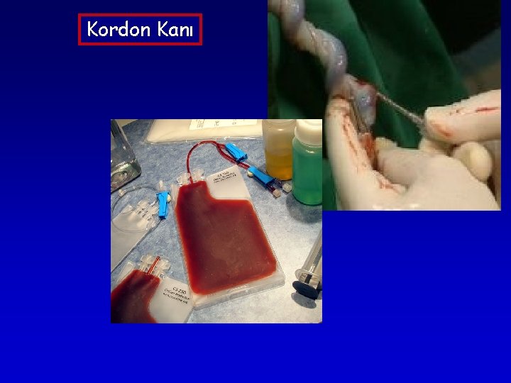 Kordon Kanı Kordon Kanı