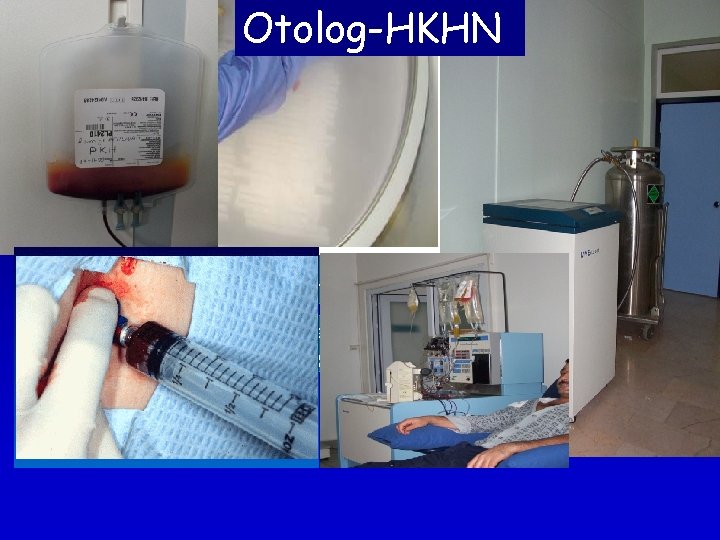 İlk Otolog-HKHN Tedavi Lenfoma Nüks için kurtarma tedavisi Yanıt Nüks Kök hücreler toplanır, saklanır İlk Otolog-HKHN Tedavi Lenfoma Nüks için kurtarma tedavisi Yanıt Nüks Kök hücreler toplanır, saklanır