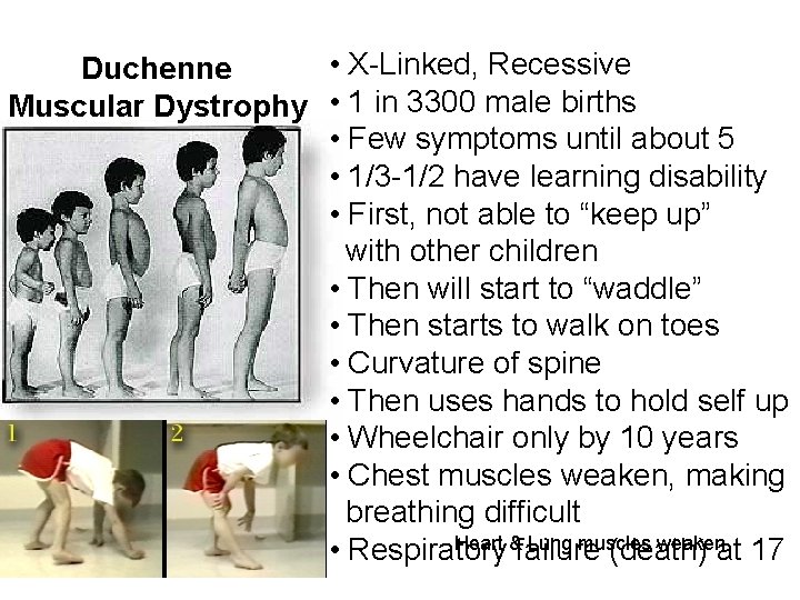  • X-Linked, Recessive Duchenne Muscular Dystrophy • 1 in 3300 male births •