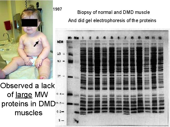 1987 Biopsy of normal and DMD muscle And did gel electrophoresis of the proteins