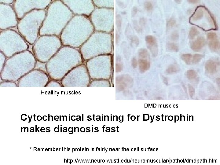 Healthy muscles DMD muscles Cytochemical staining for Dystrophin makes diagnosis fast * Remember this