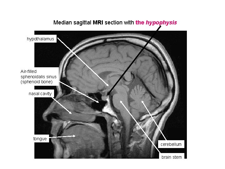 Median sagittal MRI section with the hypophysis hypothalamus Air-filled sphenoidalis sinus (sphenoid bone) nasal