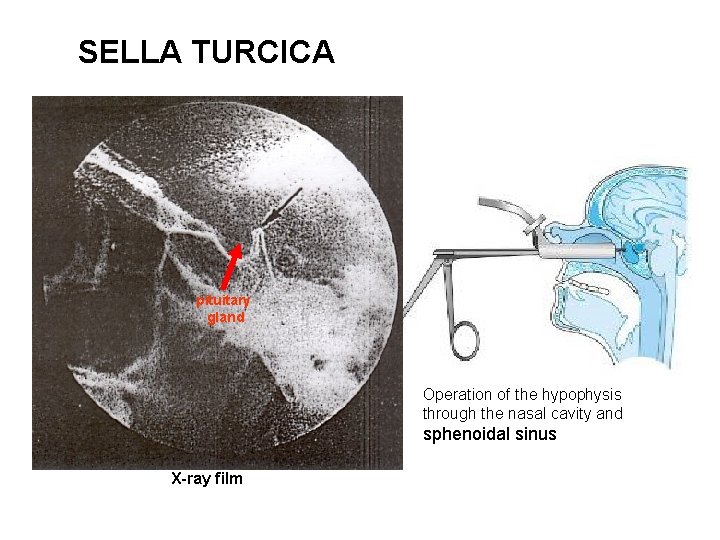 SELLA TURCICA pituitary gland Operation of the hypophysis through the nasal cavity and sphenoidal