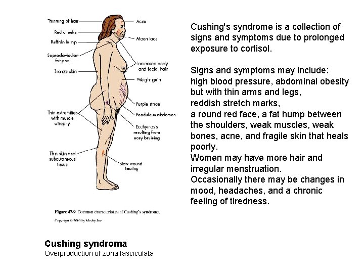 Cushing's syndrome is a collection of signs and symptoms due to prolonged exposure to