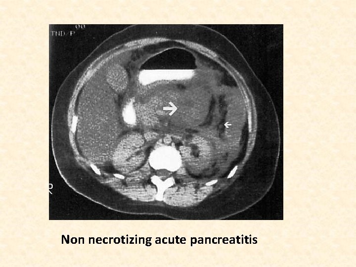 Non necrotizing acute pancreatitis 