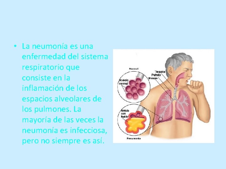  • La neumonía es una enfermedad del sistema respiratorio que consiste en la