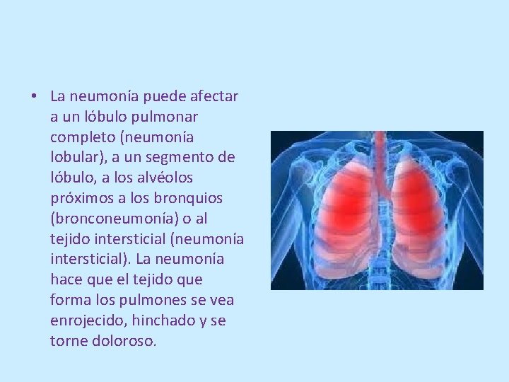  • La neumonía puede afectar a un lóbulo pulmonar completo (neumonía lobular), a