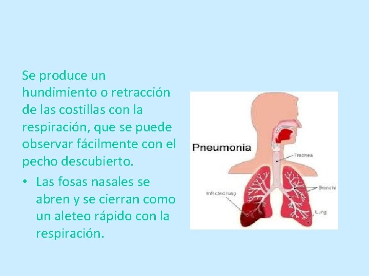 Se produce un hundimiento o retracción de las costillas con la respiración, que se