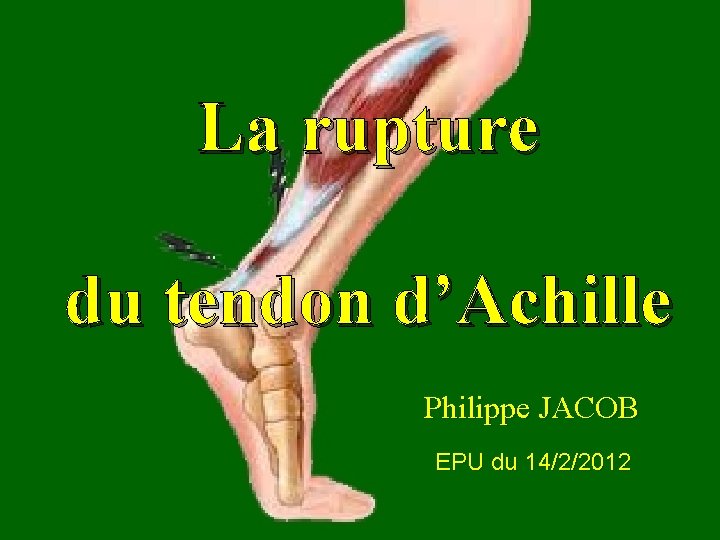 La rupture du tendon d’Achille Philippe JACOB EPU du 14/2/2012 